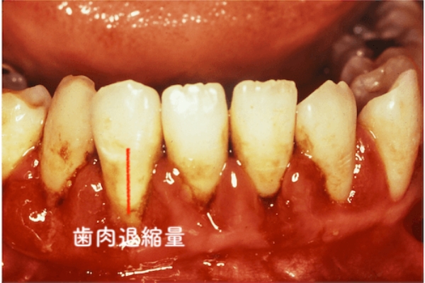  歯肉退縮量の検査   
