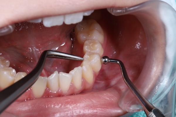歯の揺れを検査    